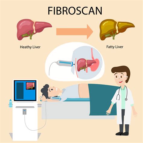 who needs a fibroscan